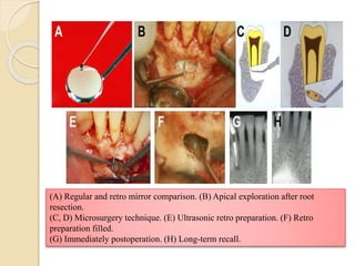 (A) Regular and retro mirror comparison. (B) Apical exploration after root
resection.
(C, D) Microsurgery technique. (E) Ultrasonic retro preparation. (F) Retro
preparation filled.
(G) Immediately postoperation. (H) Long-term recall.
 