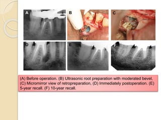 (A) Before operation. (B) Ultrasonic root preparation with moderated bevel,
(C) Micromirror view of retropreparation, (D) Immediately postoperation. (E)
5-year recall. (F) 10-year recall.
 