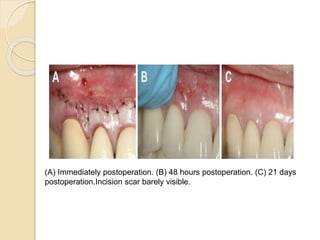 (A) Immediately postoperation. (B) 48 hours postoperation. (C) 21 days
postoperation.Incision scar barely visible.
 