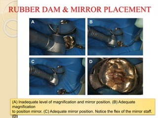 RUBBER DAM & MIRROR PLACEMENT
(A) Inadequate level of magnification and mirror position. (B) Adequate
magnification
to position mirror. (C) Adequate mirror position. Notice the flex of the mirror staff.
(D)
 
