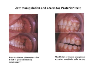 Jaw manipulation and access for Posterior teeth
Lateral extrusion gains another1/2 to
1-inch of space for maxillary
molar surgery
Mandibular protrusion gives greater
access for mandibular molar surgery
 