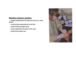 Maxillary Anterior position
* surgeon positioned to the right and to the rear of the
patient
* occlusal plane perpendicular to the floor
* patient looking straight ahead
* scope angled down the plane of the roots
* dental chair position low
 