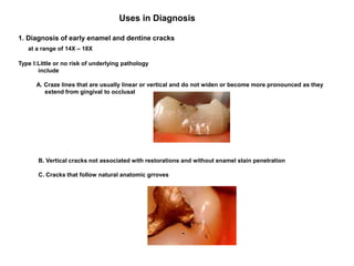 Uses in Diagnosis
1. Diagnosis of early enamel and dentine cracks
at a range of 14X – 18X
Type I:Little or no risk of underlying pathology
include
A. Craze lines that are usually linear or vertical and do not widen or become more pronounced as they
extend from gingival to occlusal
B. Vertical cracks not associated with restorations and without enamel stain penetration
C. Cracks that follow natural anatomic grroves
 