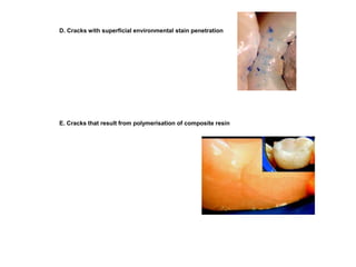 D. Cracks with superficial environmental stain penetration
E. Cracks that result from polymerisation of composite resin
 