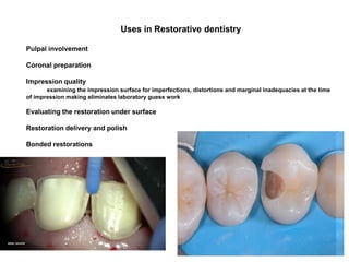 Uses in Restorative dentistry
Pulpal involvement
Coronal preparation
Impression quality
examining the impression surface for imperfections, distortions and marginal inadequacies at the time
of impression making eliminates laboratory guess work
Evaluating the restoration under surface
Restoration delivery and polish
Bonded restorations
 