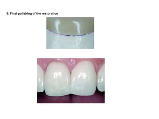 6. Final polishing of the restoration
 