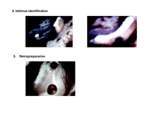 4. Isthmus identification
5. Retroprepararion
 