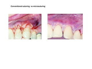 Conventional suturing vs microsuturing
 