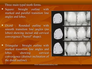 Three main typal tooth forms.Three main typal tooth forms.
 Square: Straight outline withSquare: Straight outline with
ma...