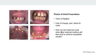 ©NYCdentist.com
Photos of Initial Presentation
• Years of Neglect
• Fear of change, pain, failure &
costs
• How can we break this cycle
when ALL treatment options will
take time to achieve acceptable
results?
 