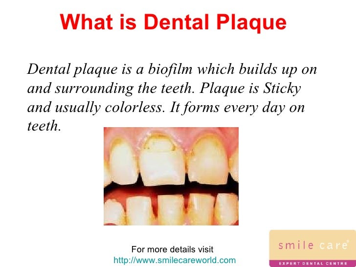 Dental plaque dental plaque