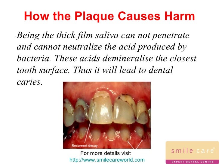 dental plaque how does plaque form