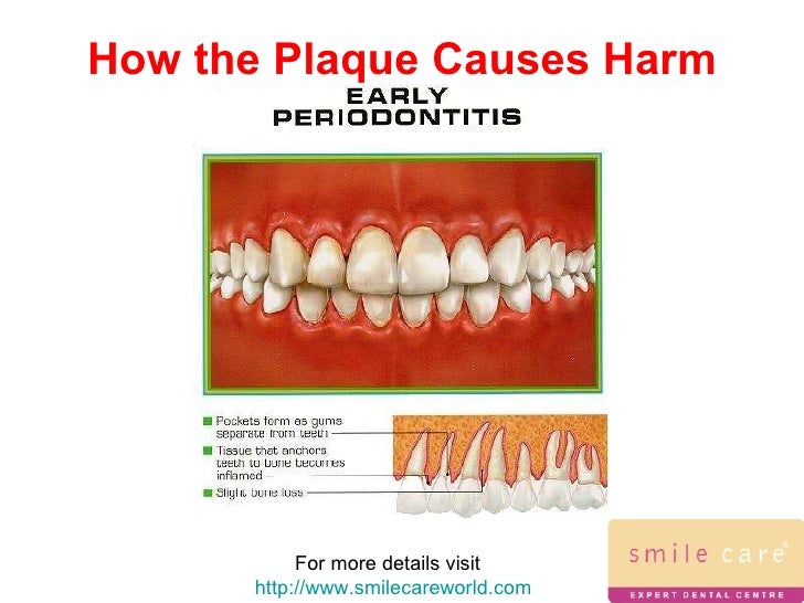 Dental plaque