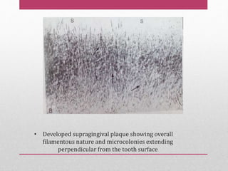 • Developed supragingival plaque showing overall
filamentous nature and microcolonies extending
perpendicular from the tooth surface
 