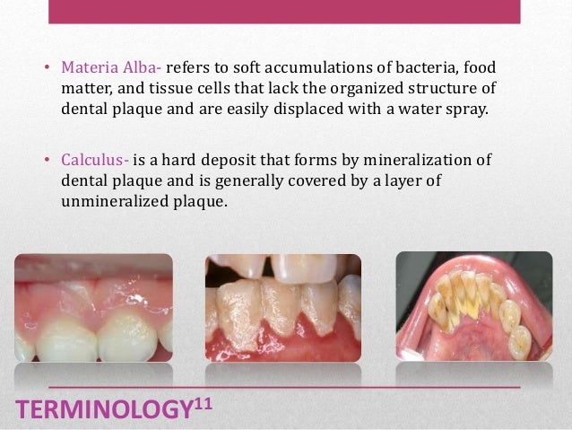 Dental Plaque