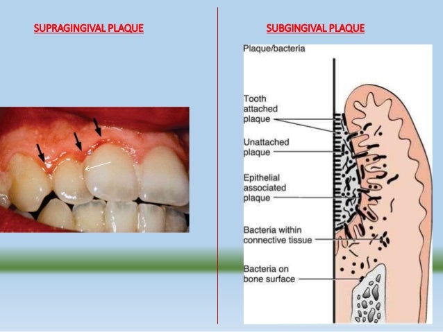 Dental plaque