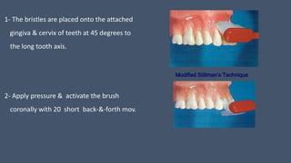 1- The bristles are placed onto the attached
gingiva & cervix of teeth at 45 degrees to
the long tooth axis.
2- Apply pressure & activate the brush
coronally with 20 short back-&-forth mov.
Modified Stillman’s Technique
 