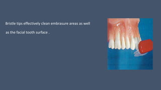Bristle tips effectively clean embrasure areas as well
as the facial tooth surface .
 