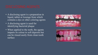 DISCLOSING AGENTS
• A disclosing agent is a preparation in
liquid, tablet or lozenge from which
contains a dye or other coloring agents
• A disclosing agent is used for
identifying bacterial plaque
• When applied to the teeth, the agents
imparts its colour to soft deposits but
can be rinsed easily from clean tooth
surface
 