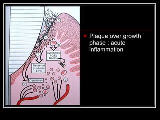 <ul><li>Plaque over growth phase : acute inflammation </li></ul>