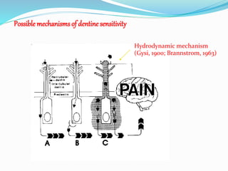 Possible mechanisms of dentine sensitivity
Hydrodynamic mechanism
(Gysi, 1900; Brannstrom, 1963)
 
