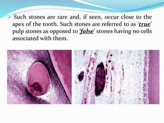  Such stones are rare and, if seen, occur close to the
apex of the tooth. Such stones are referred to as ‘true’
pulp stones as opposed to ‘false’ stones having no cells
associated with them.
 