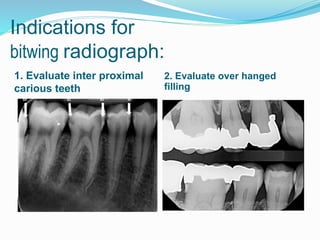 Indications for
bitwing radiograph:
1. Evaluate inter proximal
carious teeth
2. Evaluate over hanged
filling
 