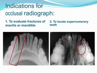 Indications for
occlusal radiograph:
1. To evaluate fractures of
maxilla or mandible
2. To locate supernumerary
teeth
 