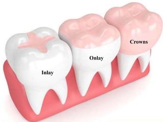 Inlay
Onlay
Crowns
 
