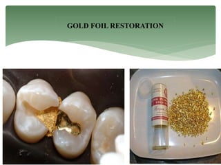 GOLD FOIL RESTORATION
 