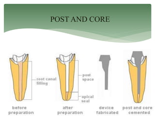 POST AND CORE
 