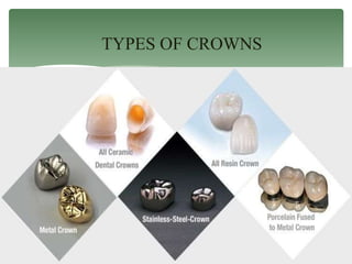TYPES OF CROWNS
 