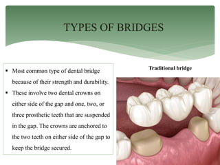 TYPES OF BRIDGES
Traditional bridge
 Most common type of dental bridge
because of their strength and durability.
 These involve two dental crowns on
either side of the gap and one, two, or
three prosthetic teeth that are suspended
in the gap. The crowns are anchored to
the two teeth on either side of the gap to
keep the bridge secured.
 