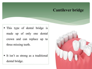 Cantilever bridge
 This type of dental bridge is
made up of only one dental
crown and can replace up to
three missing teeth.
 It isn’t as strong as a traditional
dental bridge.
 
