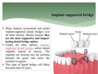 Implant supported bridge
 Many dentists recommend and prefer
implant-supported dental bridges over
all other choices. Mainly because they
are the most supportive and longest-
lasting dental bridge option.
 Unlike the other options, implant-
supported dental bridges utilize dental
implants instead of crowns. The
implants are inserted into the jawbone
through the gums and cause the
jawbone to regrow.
 This type of dental bridge will likely
last more than 25 years.
 