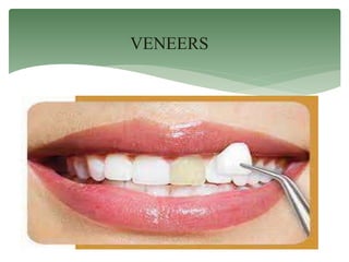 VENEERS
 