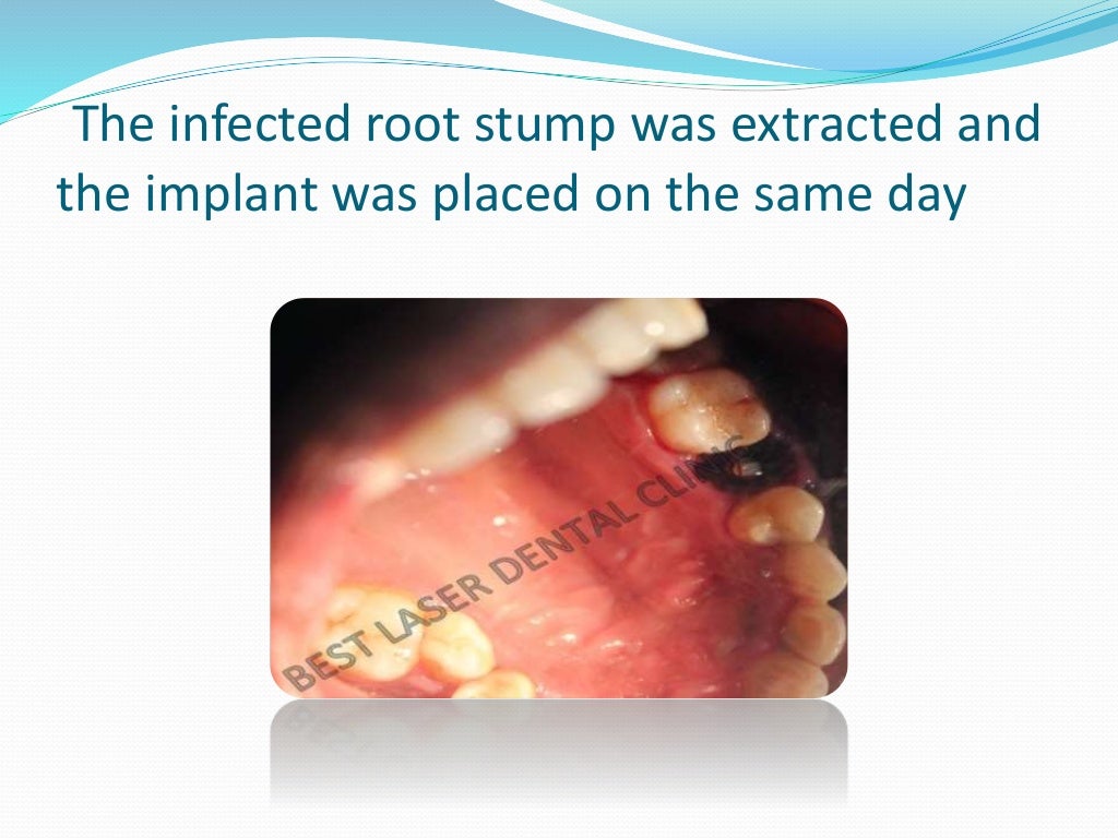 Dental root stump extraction and implant placement