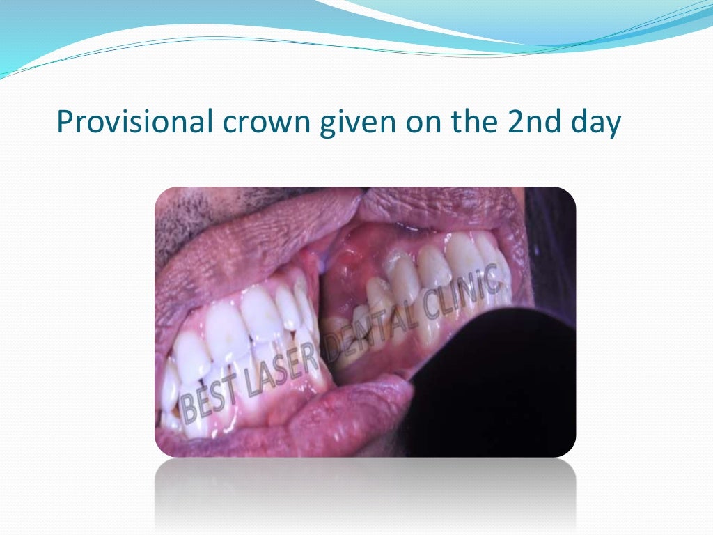 Dental root stump extraction and implant placement