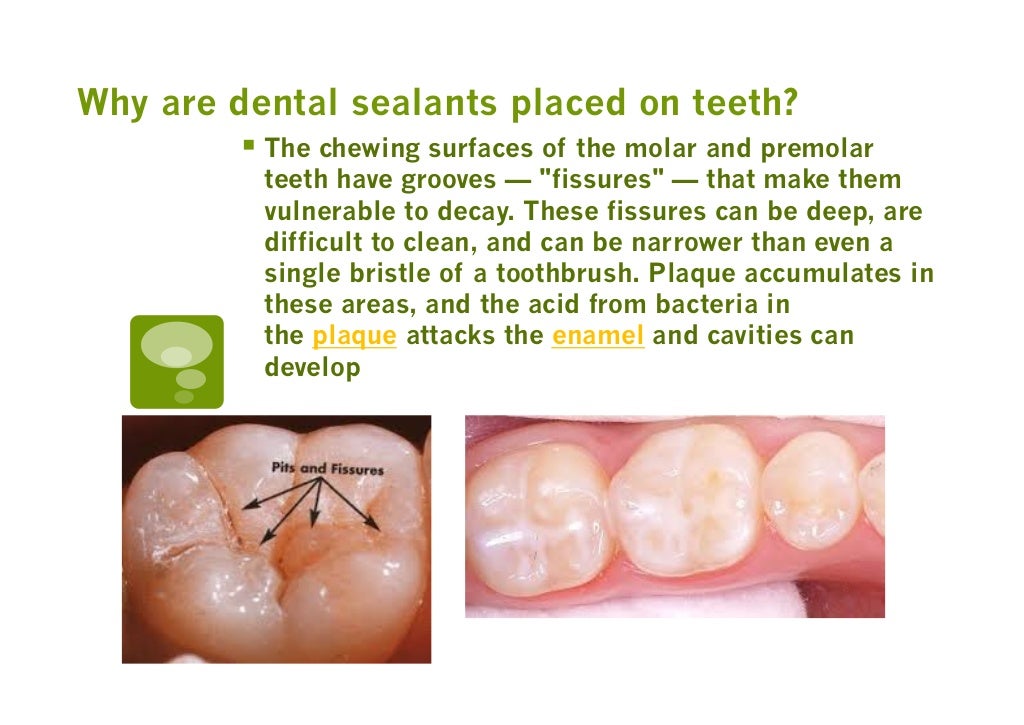 Dental sealants