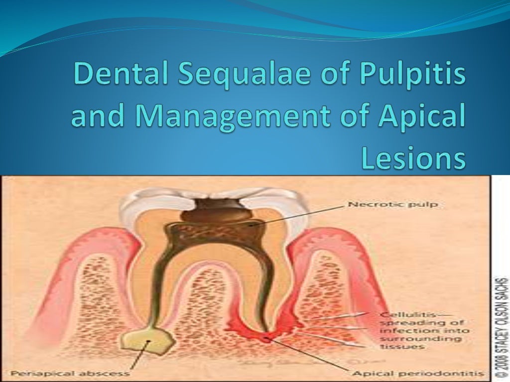 Pulpitis Skin Pulpitis: Causes, Treatment, Diagnosis, And More – DTDOOI