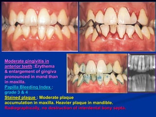 Moderate gingivitis in
anterior teeth :Erythema
& enlargement of gingiva
pronounced in mand than
in maxilla.
Papilla Bleeding Index :
grade 3 & 4
Stained plaque : Moderate plaque
accumulation in maxilla. Heavier plaque in mandible.
Radiographically, no destruction of interdental bony septa.
 