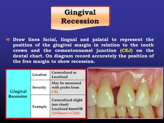 Gingival
Recession
Draw lines facial, lingual and palatal to represent the
position of the gingival margin in relation to the tooth
crown and the cementoenamel junction (CEJ) on the
dental chart. On diagram record accurately the position of
the free margin to show recession.
Generalized or
Localized
Location
Gingival
Recession
May be measured
with probe from
CEJ
Severity
Generalized slight
(see chart)
Localized 4mm#28
(Stillman's Cleft)
Example
 