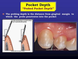 Pocket Depth
“Probed Pocket Depth”
The probing depth is the distance from gingival margin to
which the probe penetrates into the pocket
 