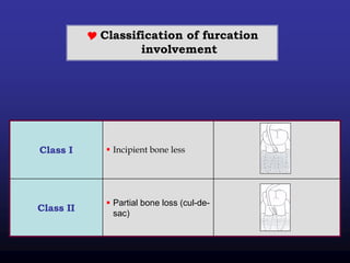  Classification of furcation
involvement
 Incipient bone lessClass I
 Partial bone loss (cul-de-
sac)
Class II
 