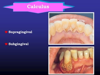 Calculus
 Supragingival
 Subgingival
 