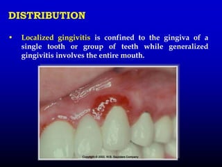 DISTRIBUTION
• Localized gingivitis is confined to the gingiva of a
single tooth or group of teeth while generalized
gingivitis involves the entire mouth.
 