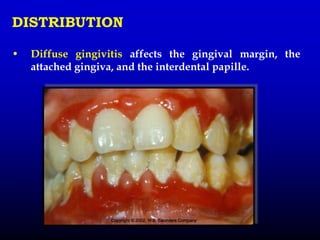 DISTRIBUTION
• Diffuse gingivitis affects the gingival margin, the
attached gingiva, and the interdental papille.
 