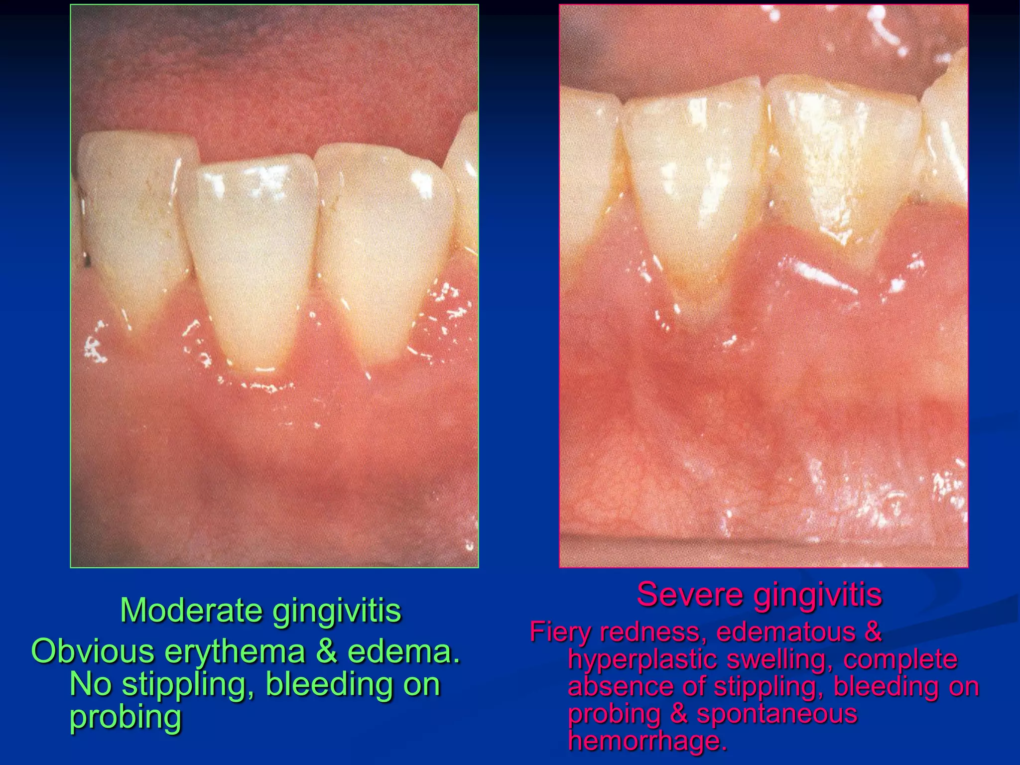 Moderate gingivitis              Severe gingivitis
                              Fiery redness, edematous &
Obvious erythema & edema.        hyperplastic swelling, complete
  No stippling, bleeding on      absence of stippling, bleeding on
  probing                        probing & spontaneous
                                 hemorrhage.
 
