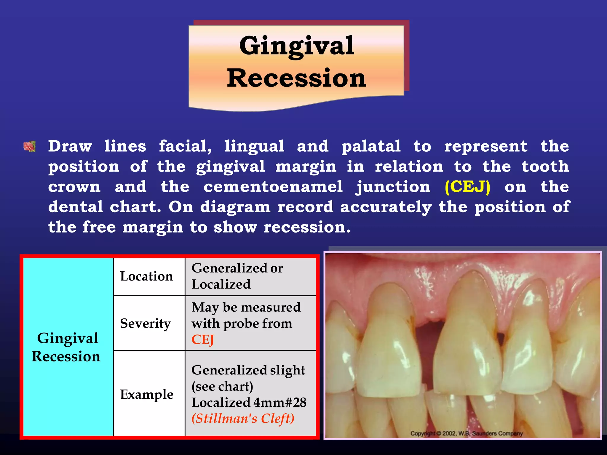 Gingival
                            Recession

  Draw lines facial, lingual and palatal to represent the
  position of the gingival margin in relation to the tooth
  crown and the cementoenamel junction (CEJ) on the
  dental chart. On diagram record accurately the position of
  the free margin to show recession.

                       Generalized or
            Location
                       Localized
                       May be measured
            Severity   with probe from
Gingival               CEJ
Recession
                       Generalized slight
                       (see chart)
            Example
                       Localized 4mm#28
                       (Stillman's Cleft)
 