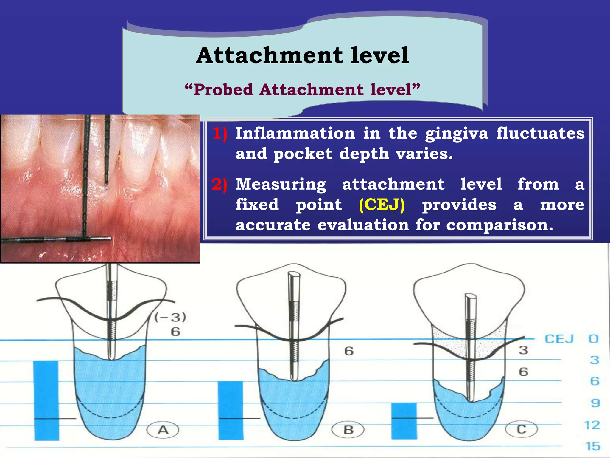 Attachment level
            “Probed Attachment level”

              1) Inflammation in the gingiva fluctuates
                 and pocket depth varies.
              2) Measuring attachment level from a
Rationale        fixed point (CEJ) provides a more
                 accurate evaluation for comparison.
 